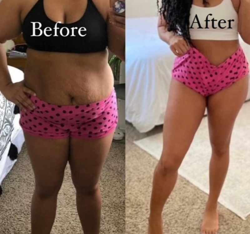 Lipolysis Injections
